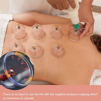 Person receiving cupping therapy with clear cups on their back, accompanied by an inset showing a negative pressure cupping device.