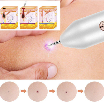 Skin Tag Remover Pen | NZ Sale