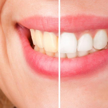 Before and after comparison of a person's smile with and without dental treatment.